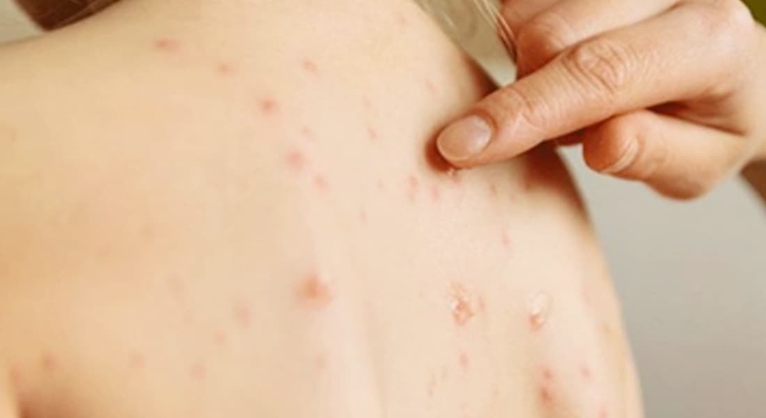 ढोरपाटनमा नियन्त्रणमा आउन थाल्यो दादुरा