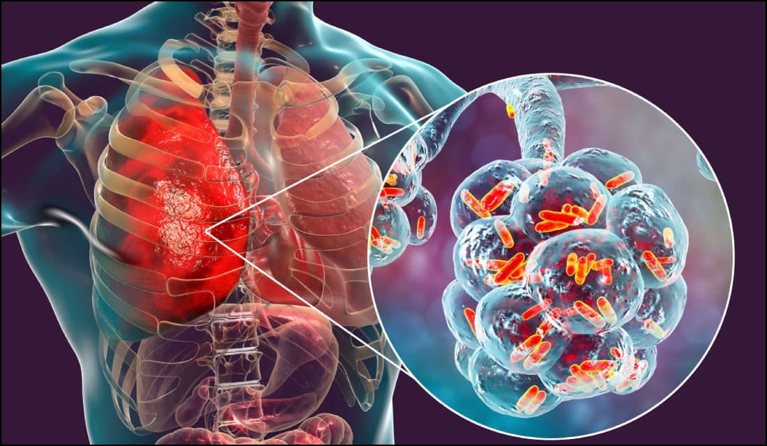 ४२ प्रतिशत क्षयरोगका बिरामी अझै उपचार बाहिर